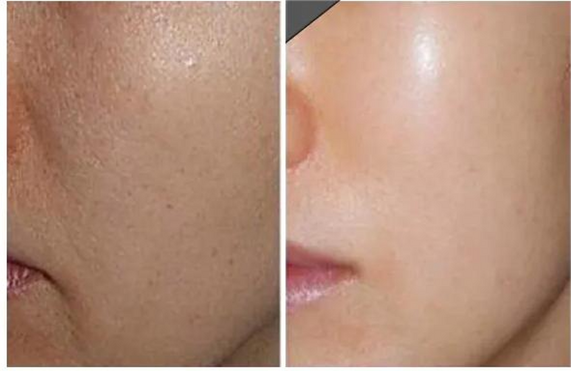 光子嫩肤的副作用 1.