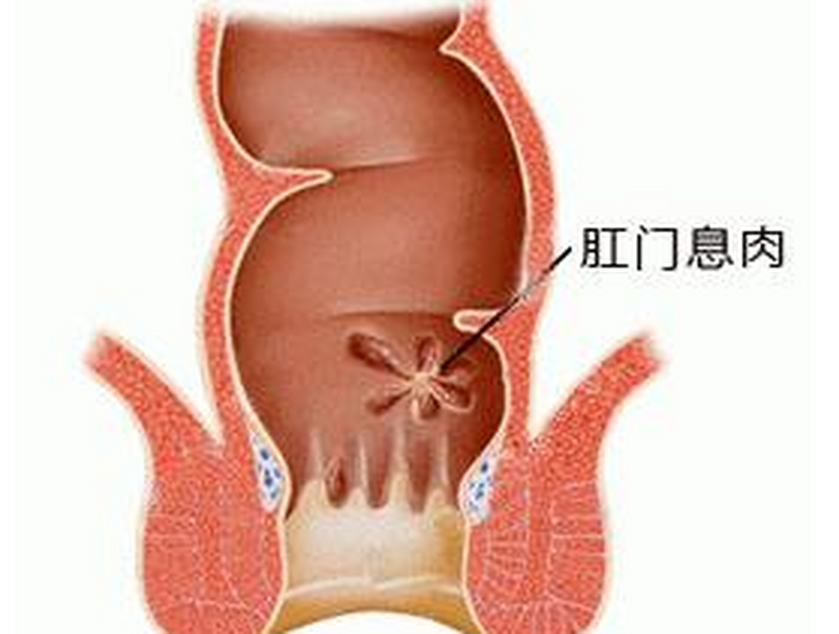 肛门外出现小肉揪是怎么回事?