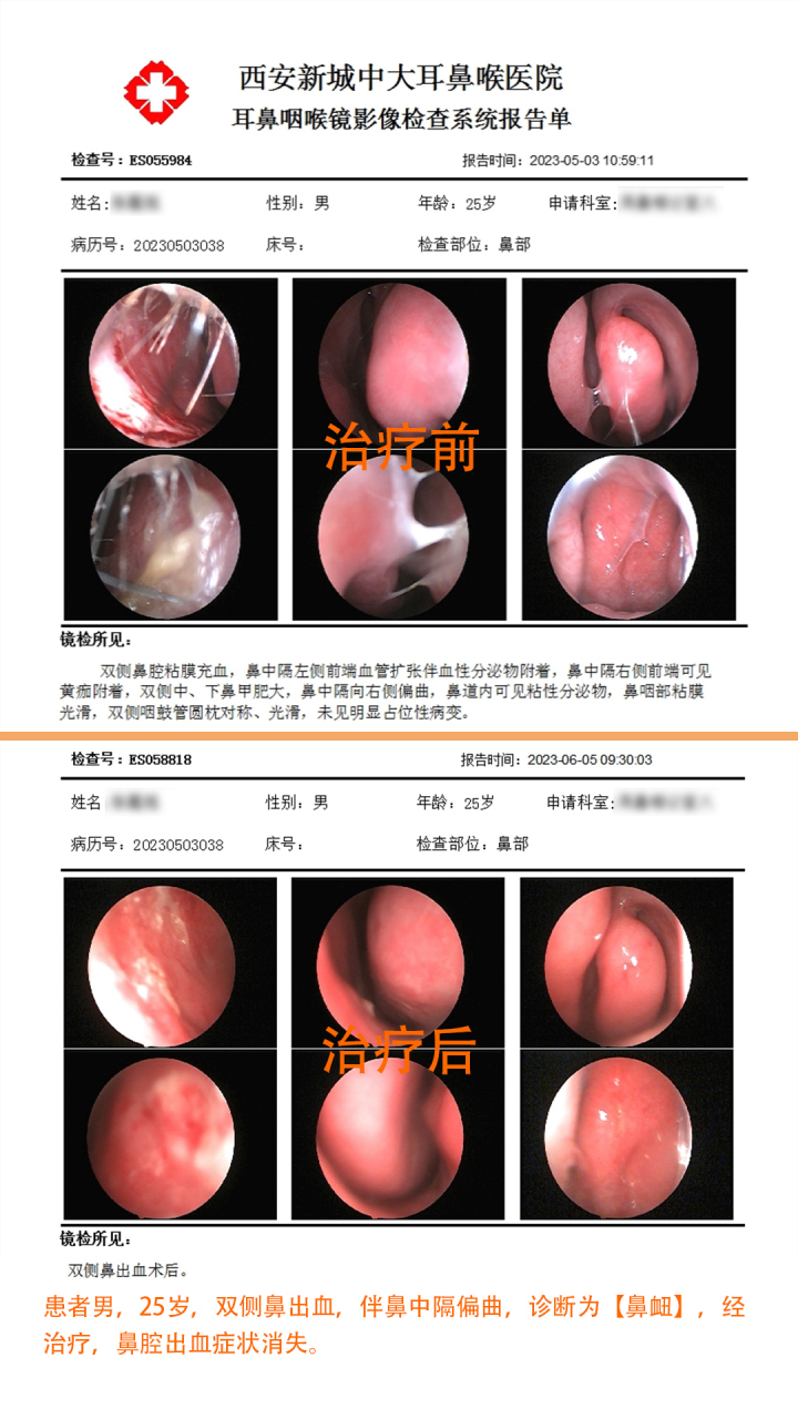 049969♂15患者男,25岁,双侧鼻出血 ,伴鼻中隔偏曲.