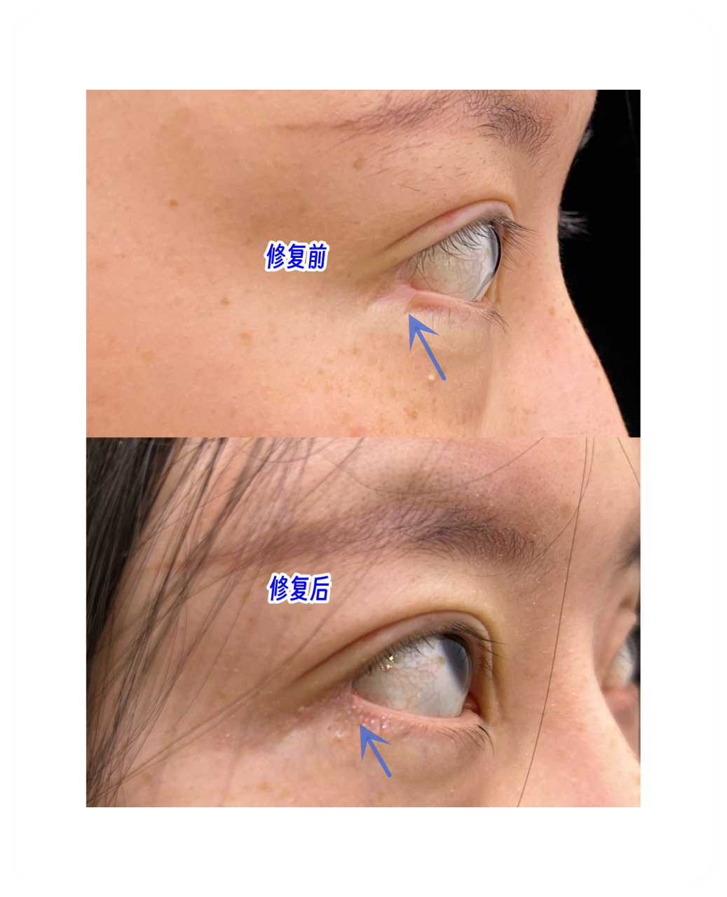 外眼角修复#  正常的眼睛,下睑缘是有个弧度,内外眼角处是往上走的
