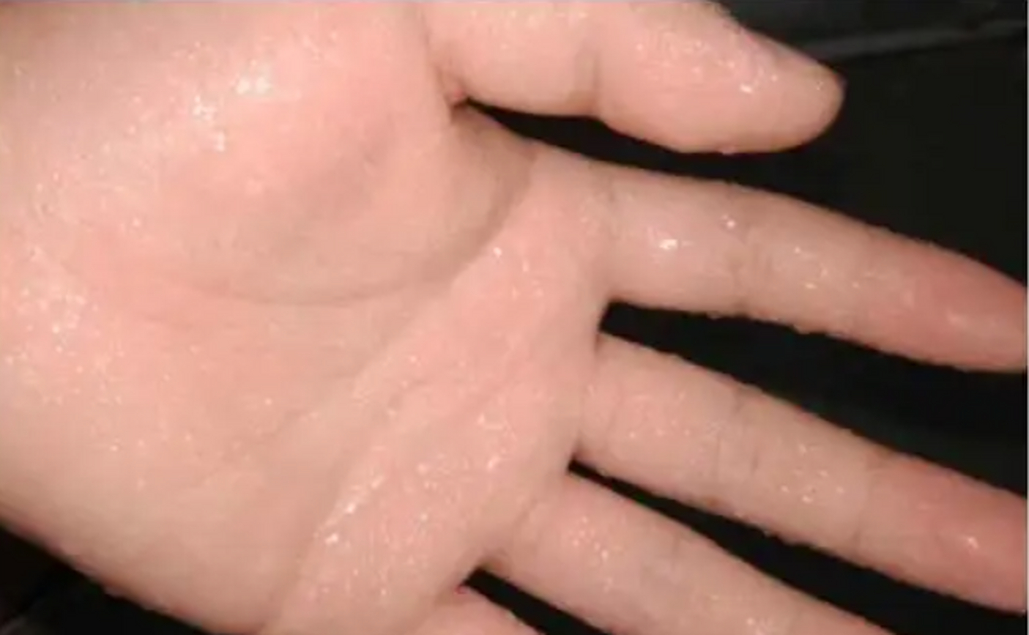 手心脚心出汗怎么治疗# 手汗症,是指手部汗腺分泌亢进的一种疾病