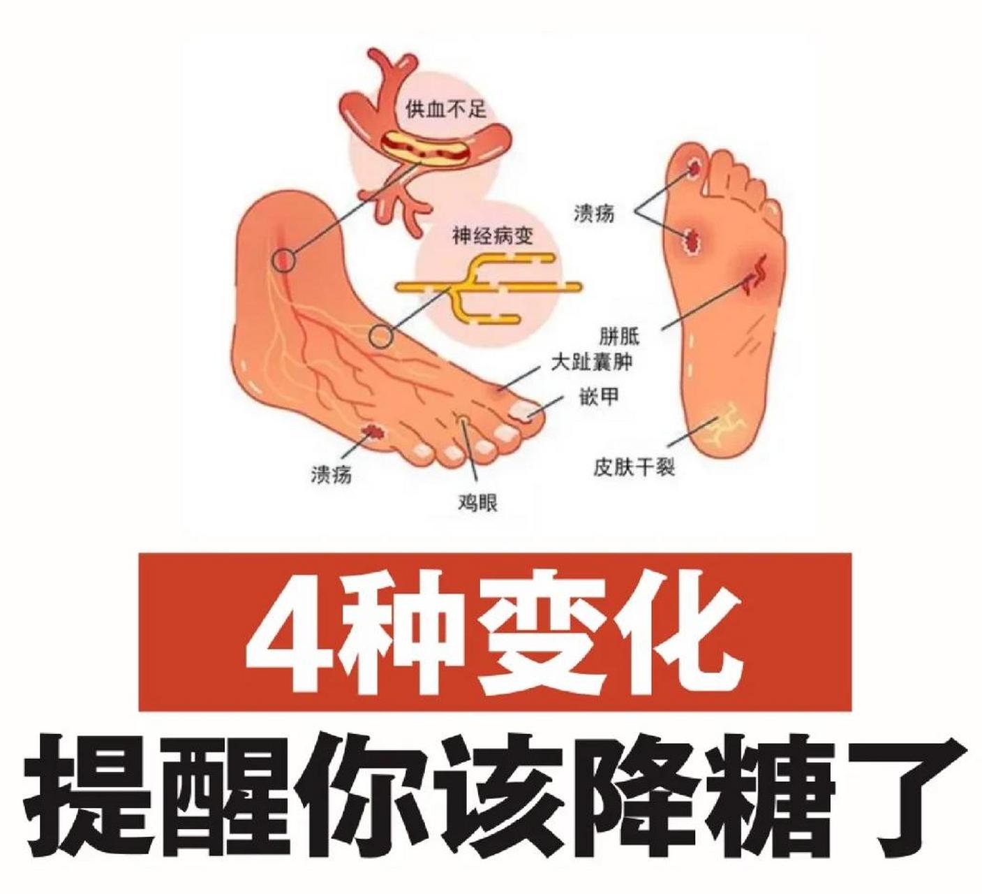 足部的4种变化,提醒你该降糖了!
