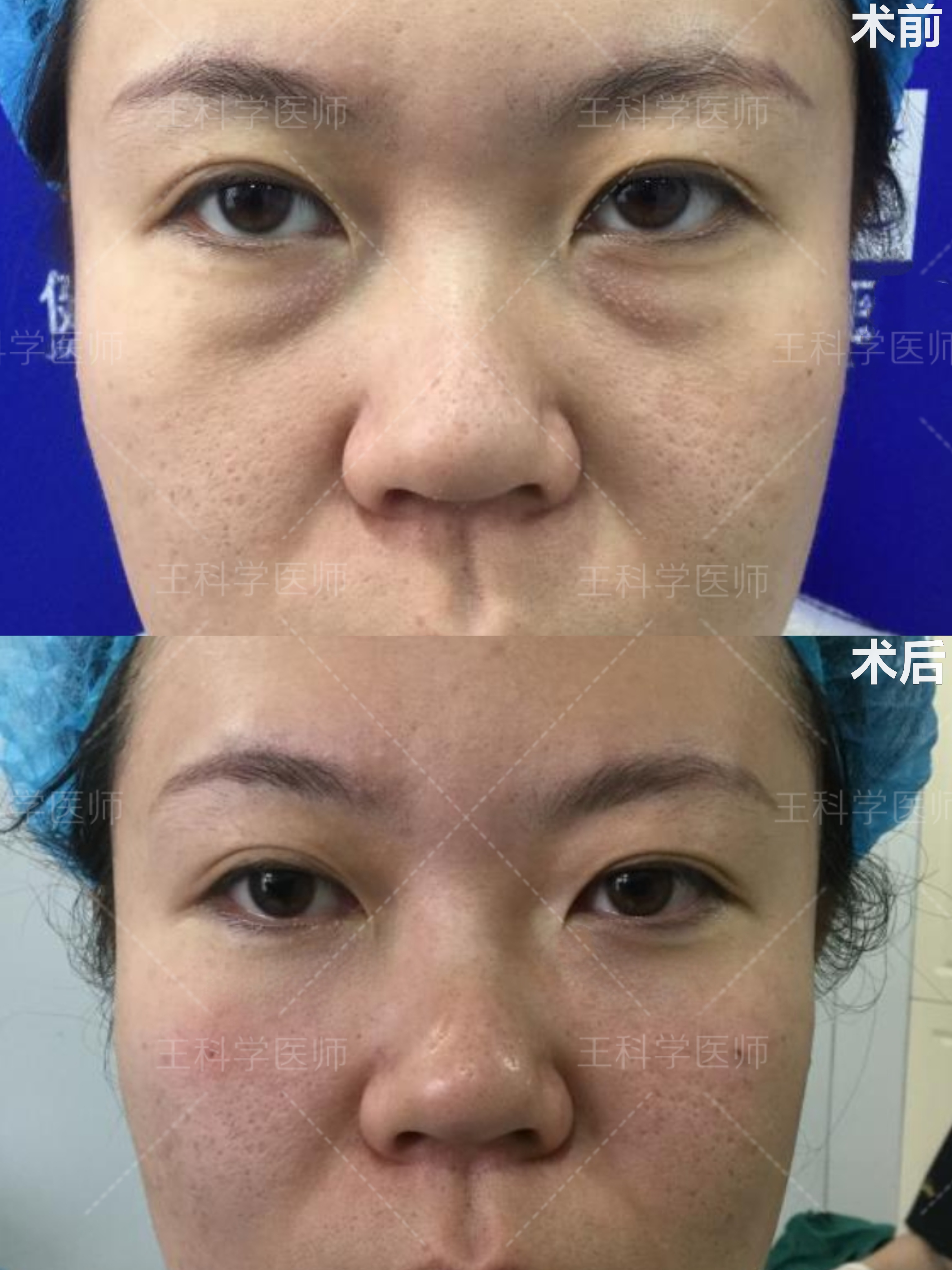 微创去眼袋同时眶隔脂肪转移填充泪沟～ 这个患者本身有卧蚕但是后来