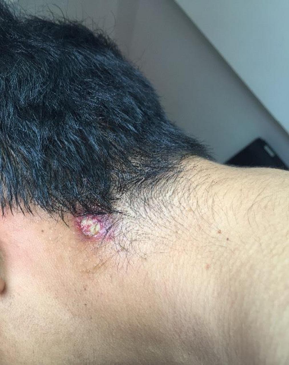 "医生医生,你看我脖子上长了一个硬疙瘩,一按可疼,需不需要做手术,我