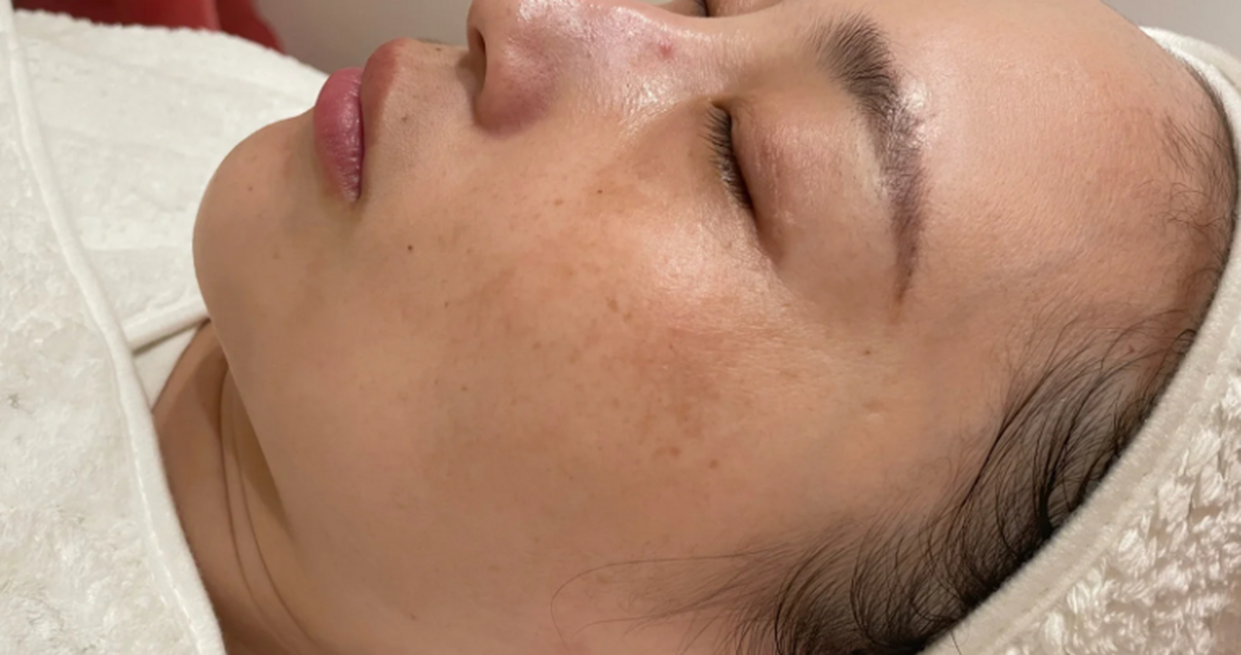 超皮秒祛斑是一种现代化的祛斑技术,它能够快速去除皮肤上的斑点和