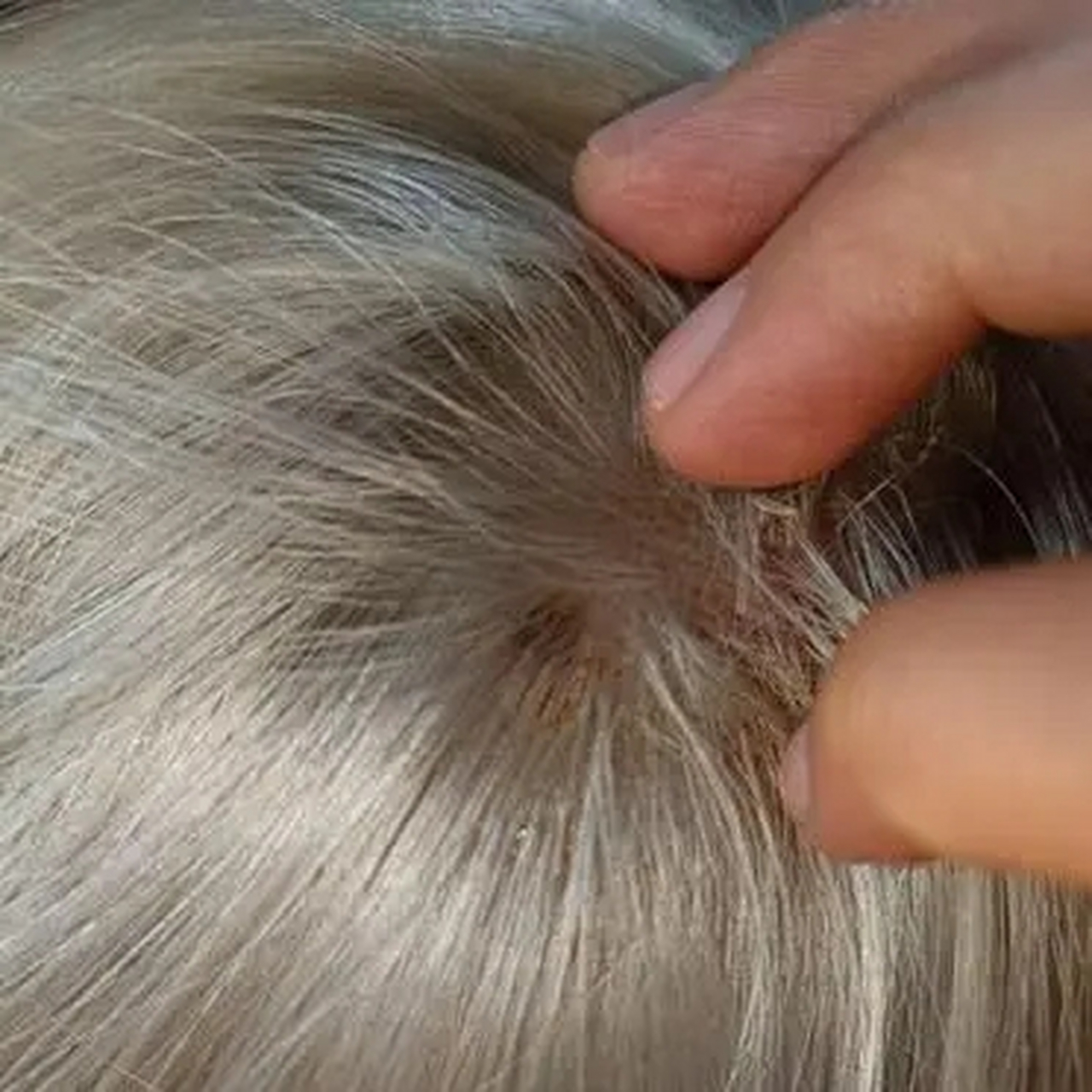 朋友们,我今天去漂白头发,结果头皮上有脓液.我该怎么办?