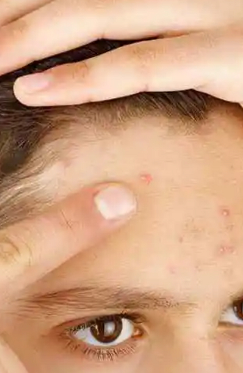 明明已经做足了护肤功夫,但脸上的痘痘依旧屡屡光顾额头