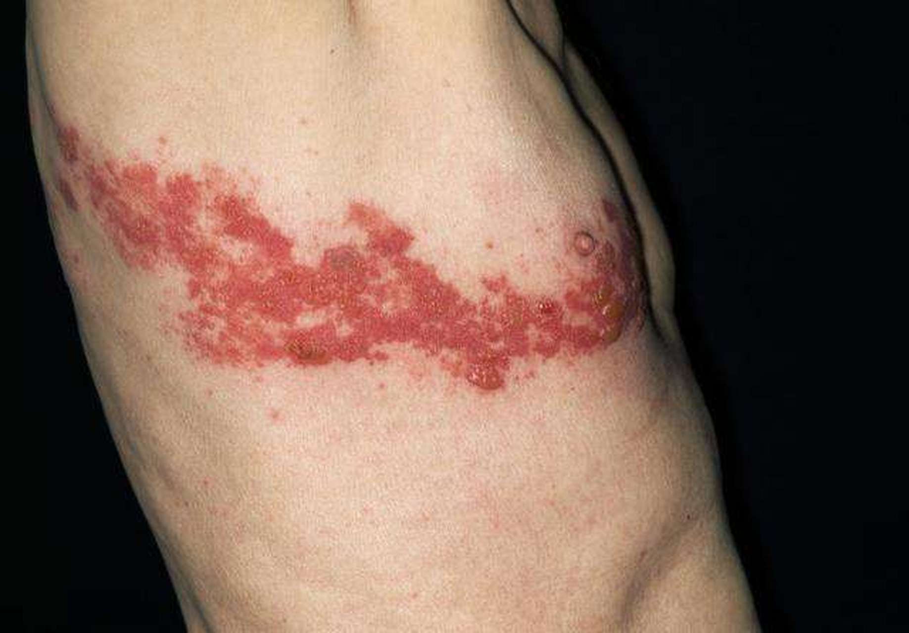 得了蛇缠腰很痛,简单3步解决它 腰部皮肤,沿单侧周围神经出现了潮红的