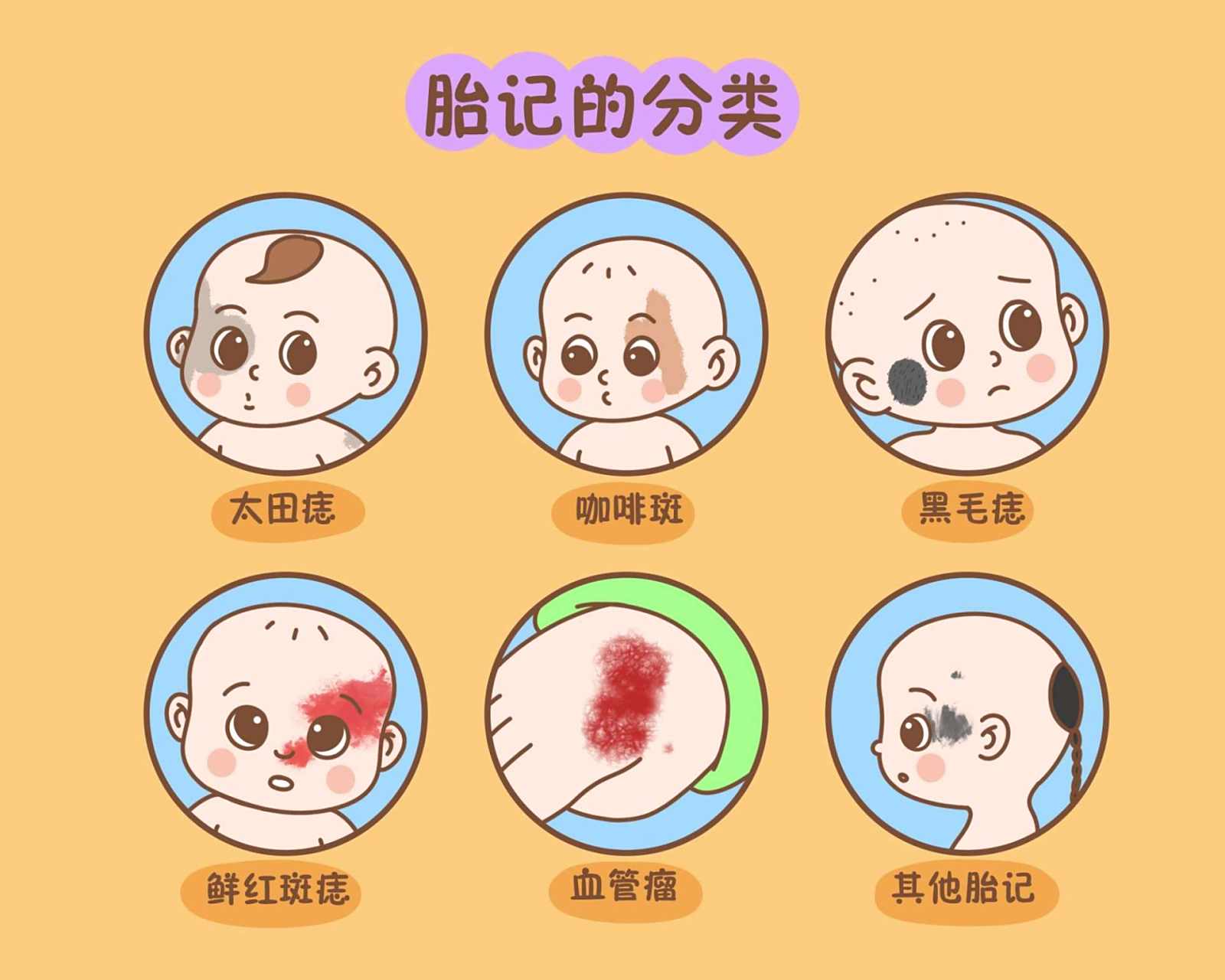 血管瘤# #胎记# #南京皮肤病研究所# #去胎记# #祛胎记# #南京胎记