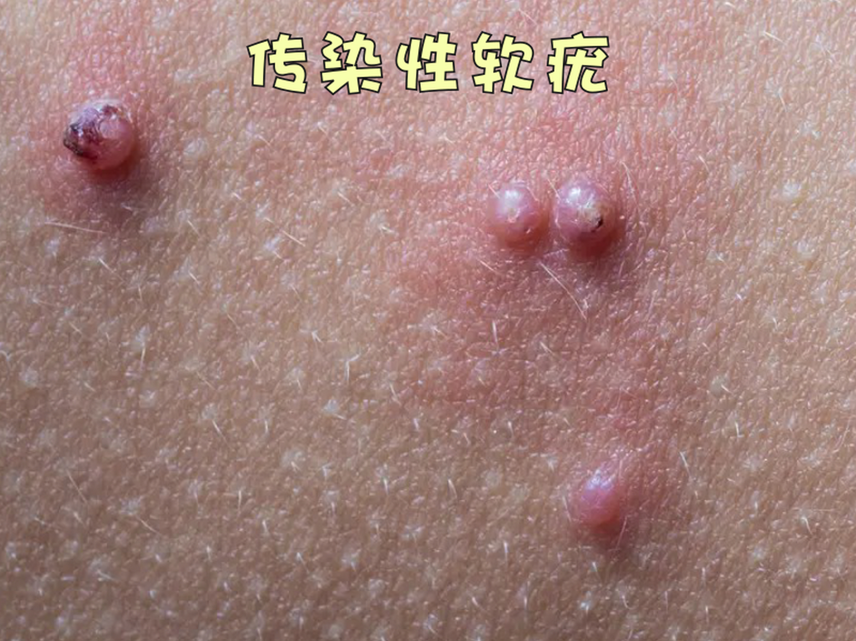 传染性软疣是一种因软疣病毒引起的具有传染性的皮肤病,民间又称怂 