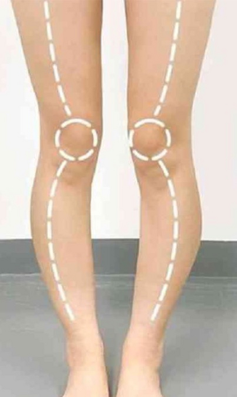 矫正xo型腿的可行性取决于多种因素,包括年龄,腿部畸形的严重程度以及