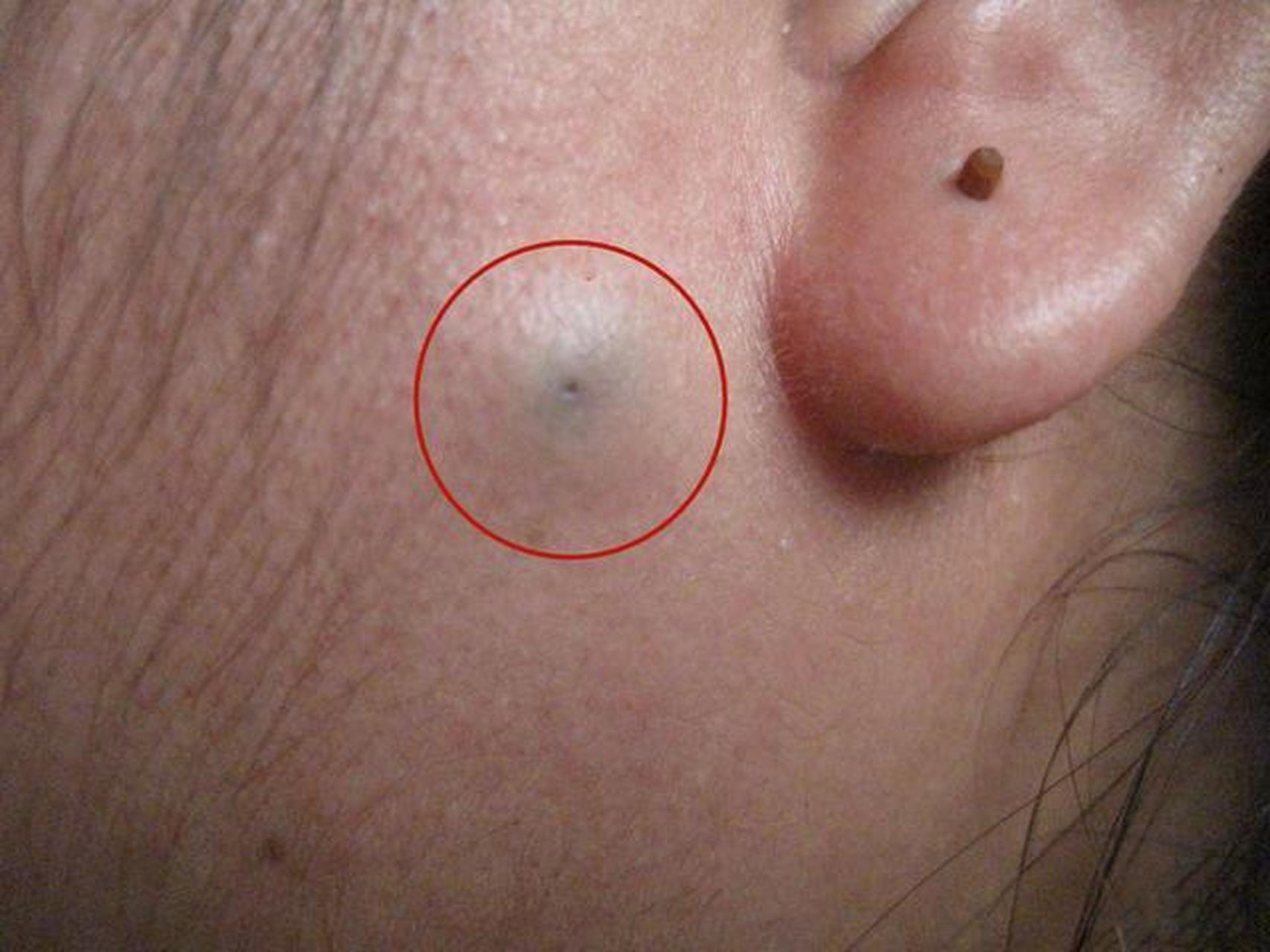 脸上鼓起这种半球形的硬包块,中间有个黑色的小洞,挤压凹陷处,能挤出