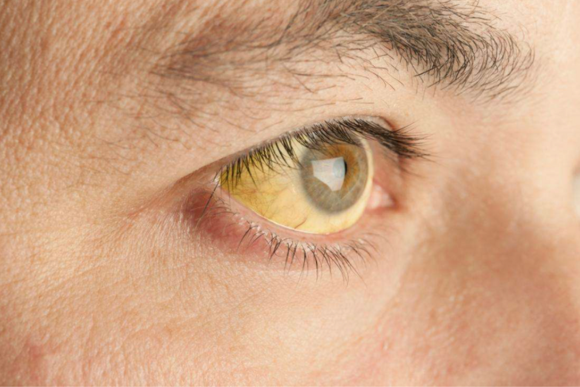 肝好不好,看眼就知道 1,眼睛出现红血丝或者是眼白发红:你如果有肝病