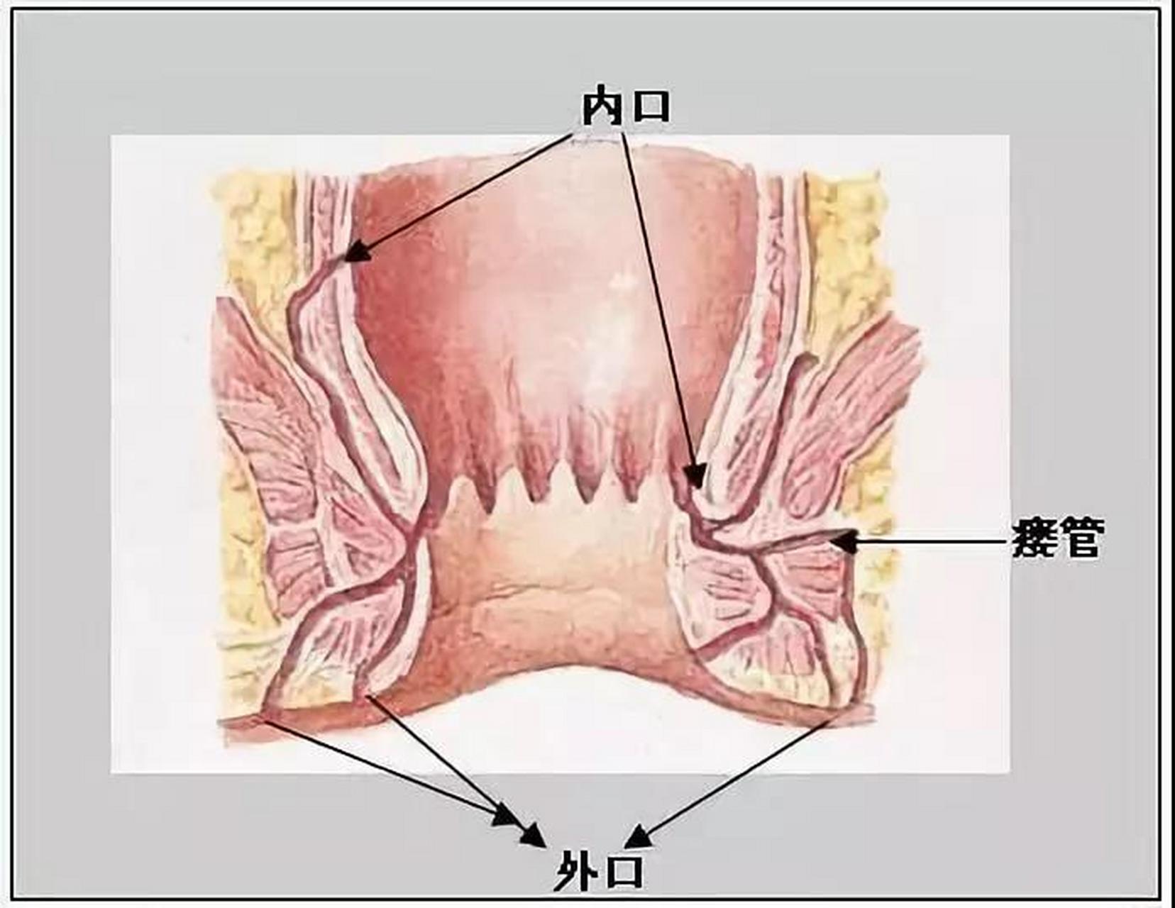 有的患者肛瘘走向十分的复杂,可能穿越括约肌以后,绕到括约肌上面