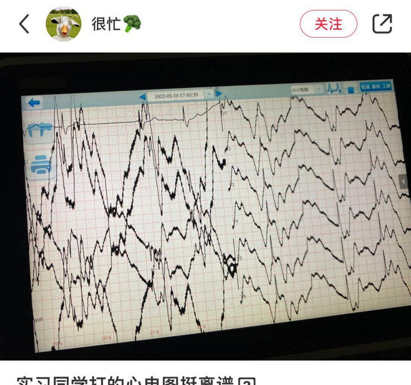这心电图有点离谱啊[左捂脸] #趣图搞笑