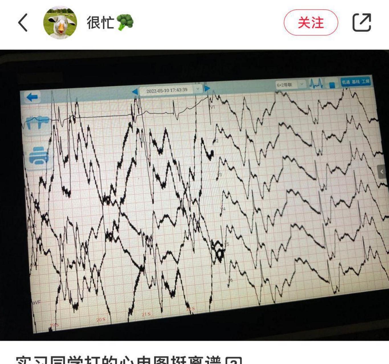 这心电图有点离谱啊[左捂脸] 