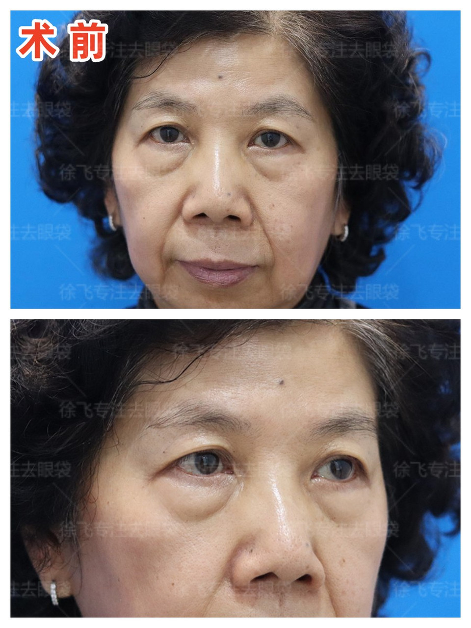 这位女士的眼袋问题十分突出,且眶周支持结构也出现了松弛现象.
