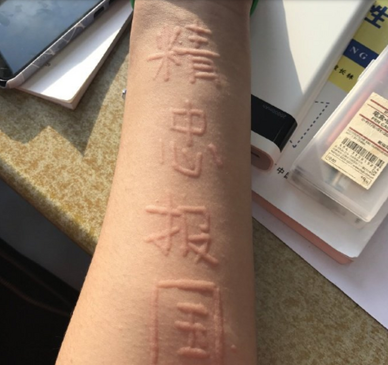 【皮肤划痕症】 荨麻疹的一种,又称人工划痕症,系过敏性荨麻疹的一种