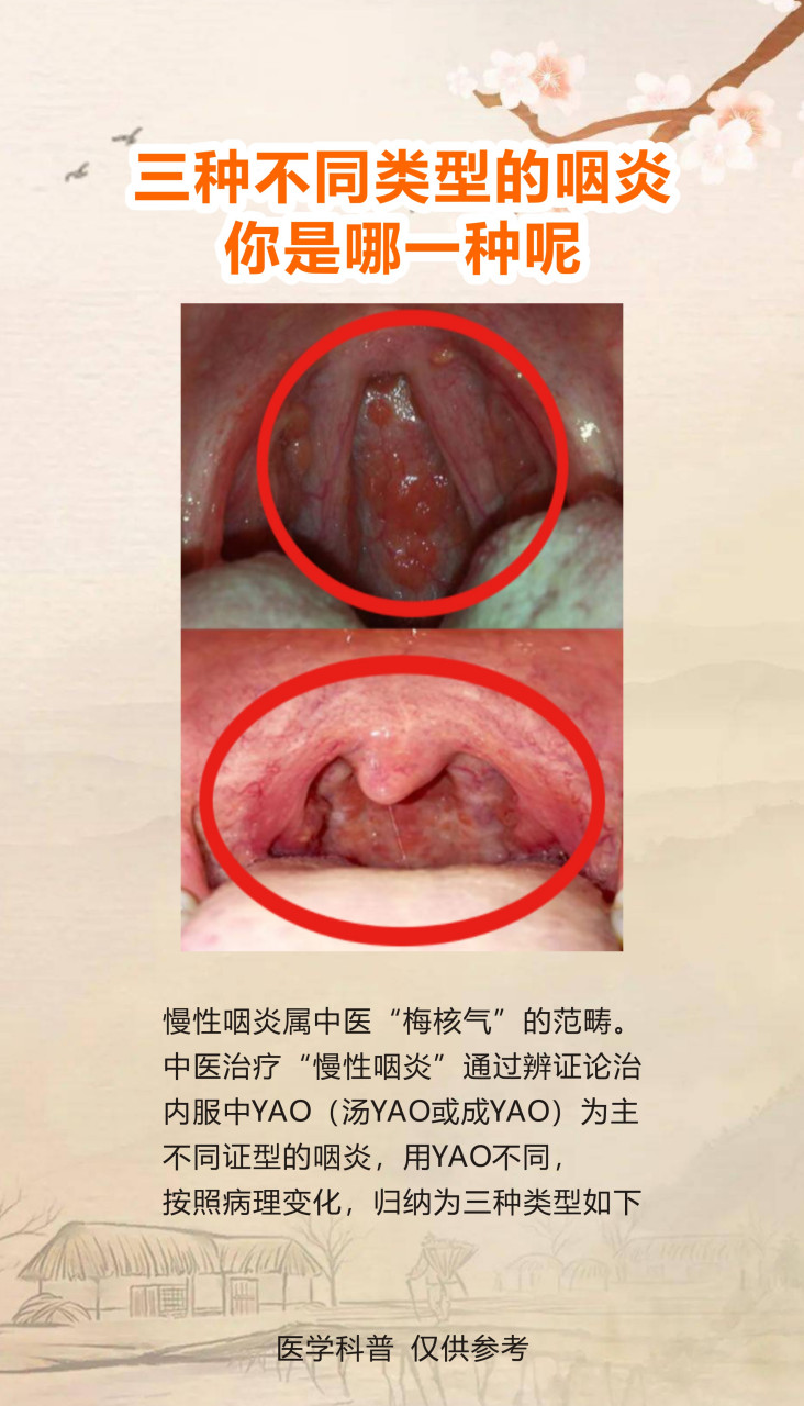 你有没有淋巴滤泡增生,出现喉咙异物感,总感觉嗓子有痰,咳不出咽不下