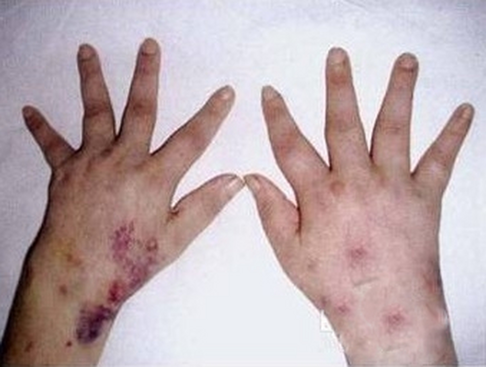 类风湿会引起皮肤病吗? 类风湿可以引起皮肤病.