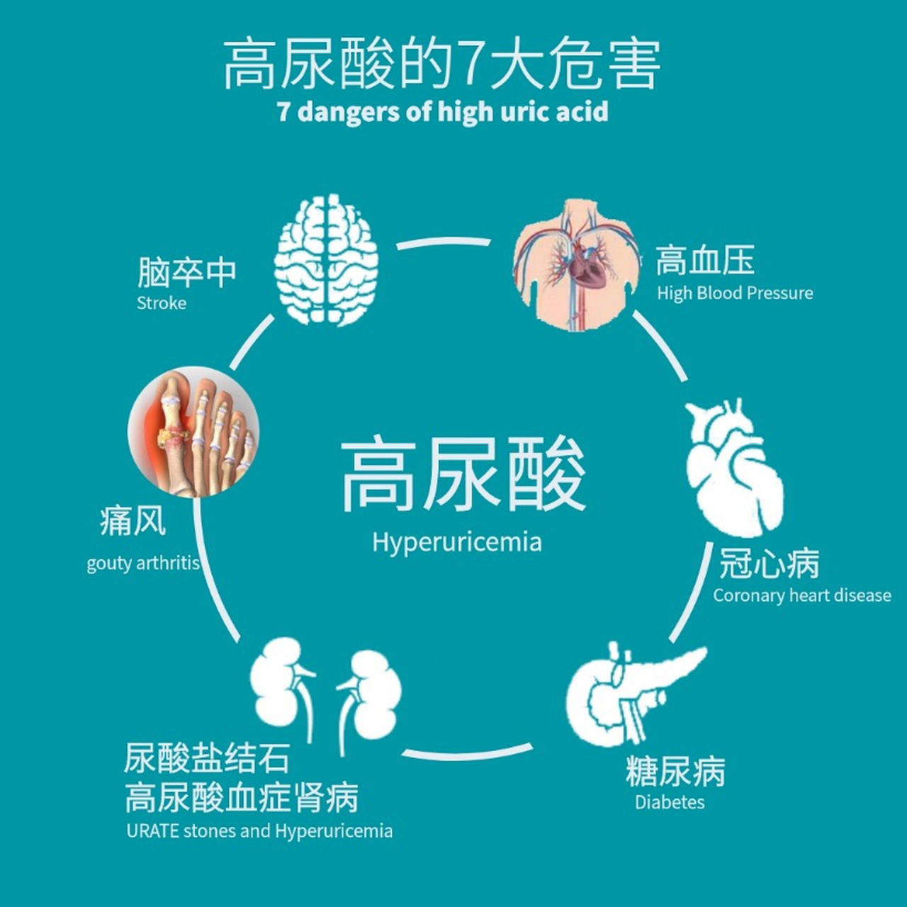 痛风科普# 痛风发作时尿酸正常,说明我没有患上痛风,医生是误 ??