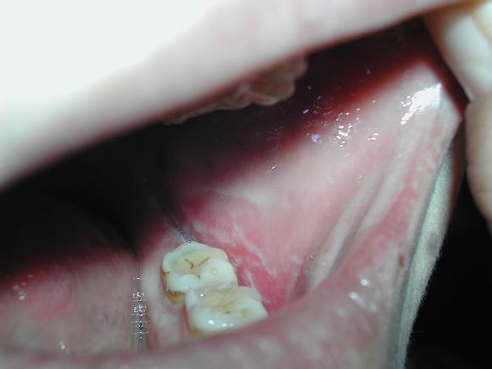 嘴里有白纹还以为是口腔溃疡,这些症状你需要知道.