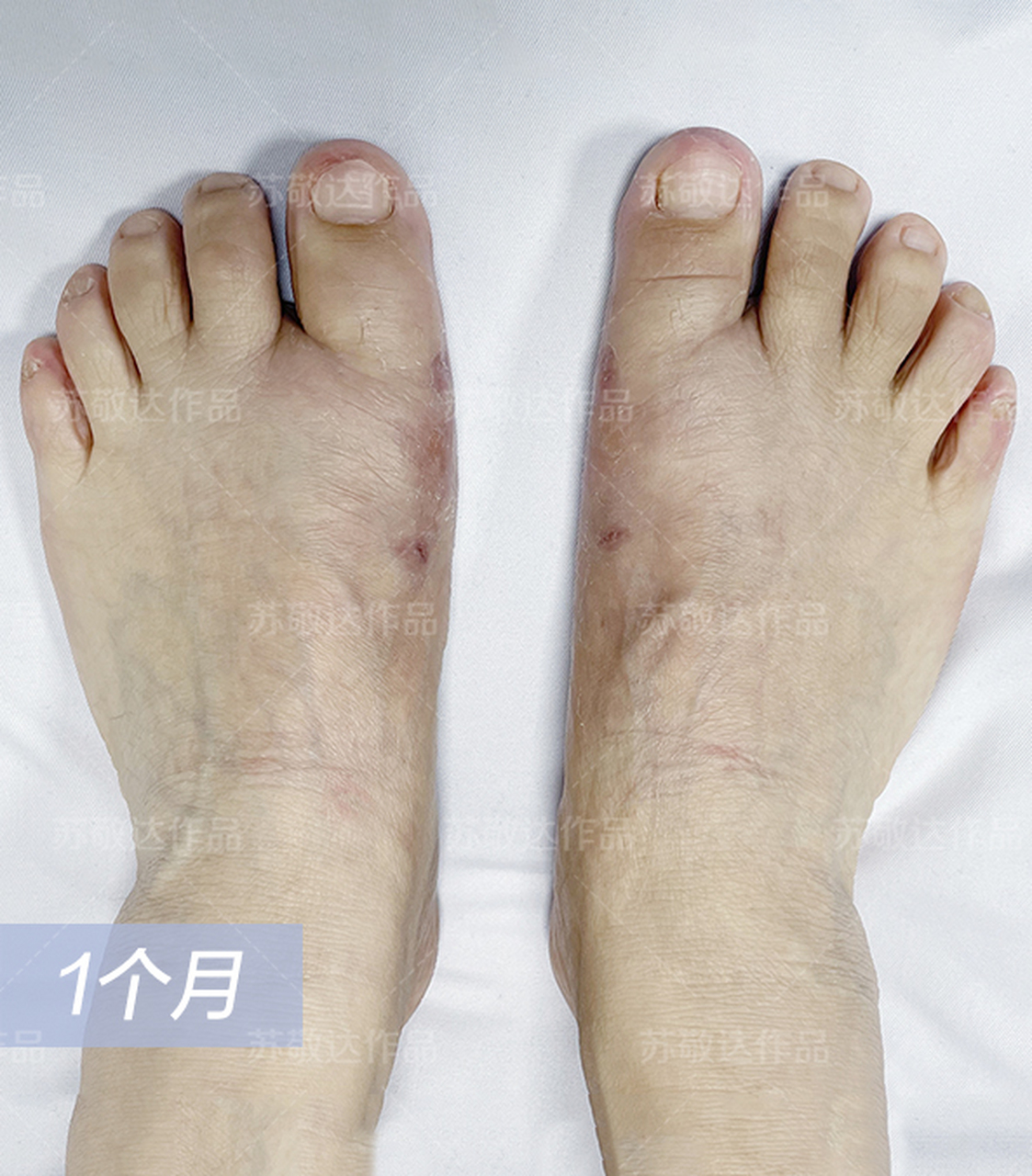 今年48了,遗传的拇外翻,一侧脚严重,骨突位置磨得发红形成拇囊炎