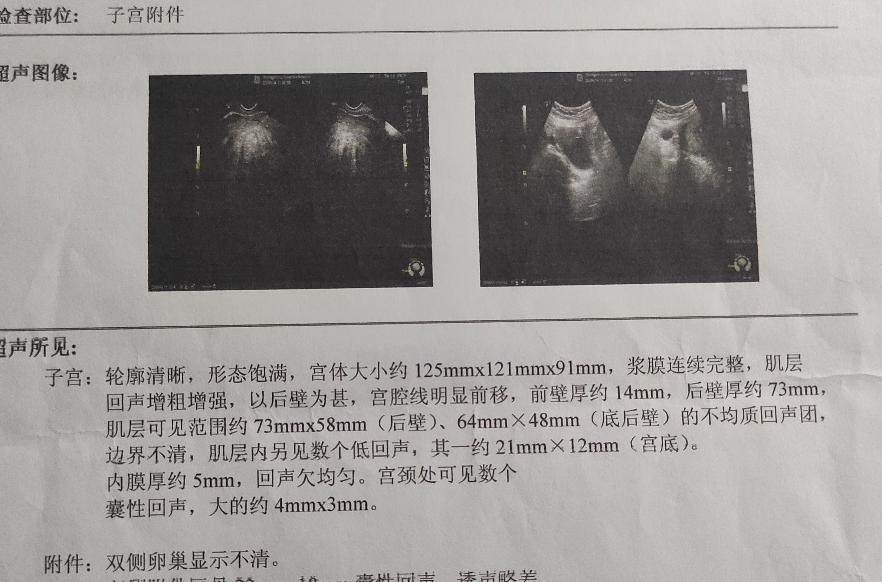 开腹挖出的子宫腺肌症病灶