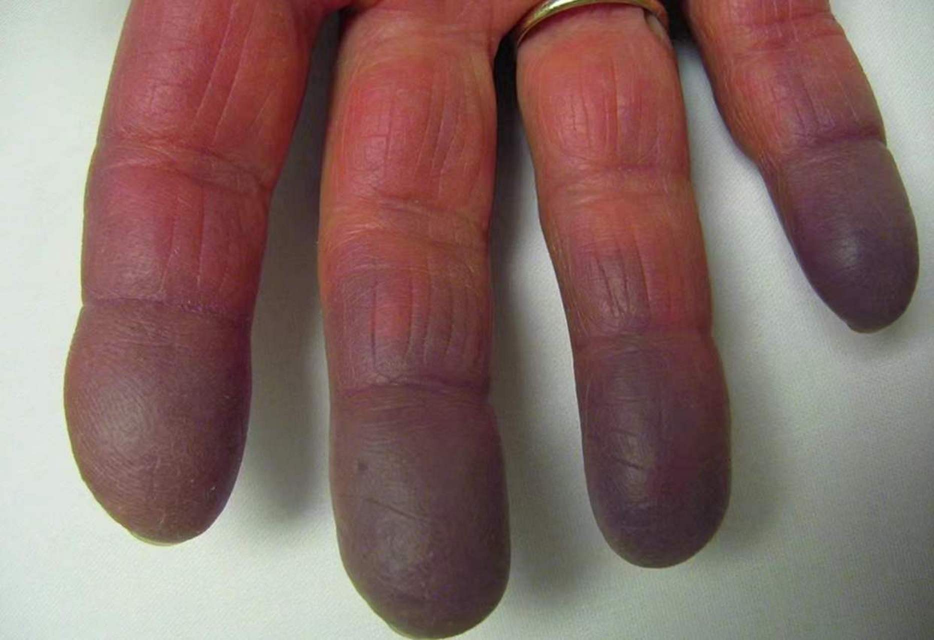 患者:大连 52岁 女性 手指遇水或冷会变白变紫,确诊为雷诺综合征,雷诺