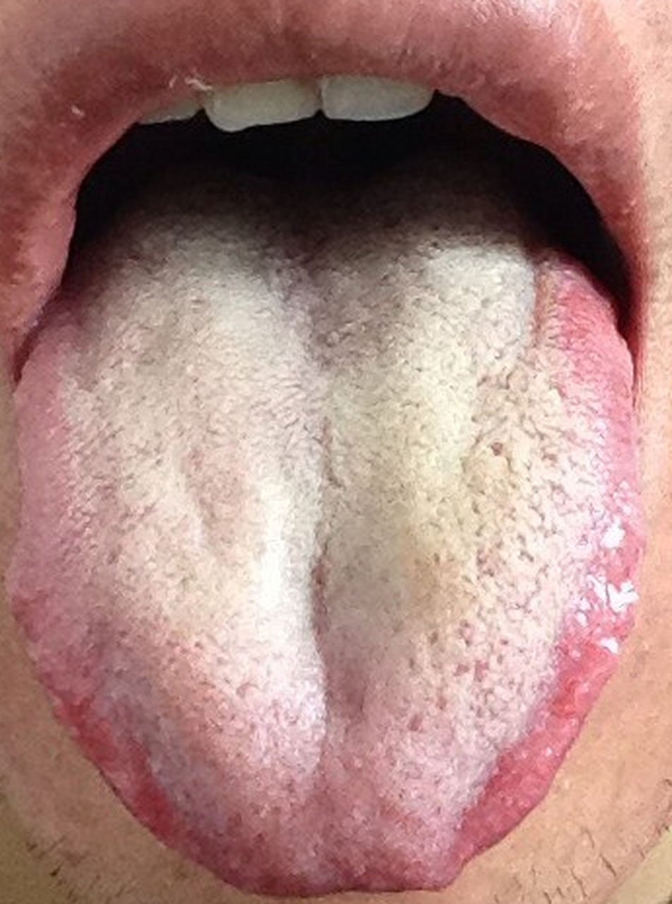 肝胆湿热的舌苔图片图片