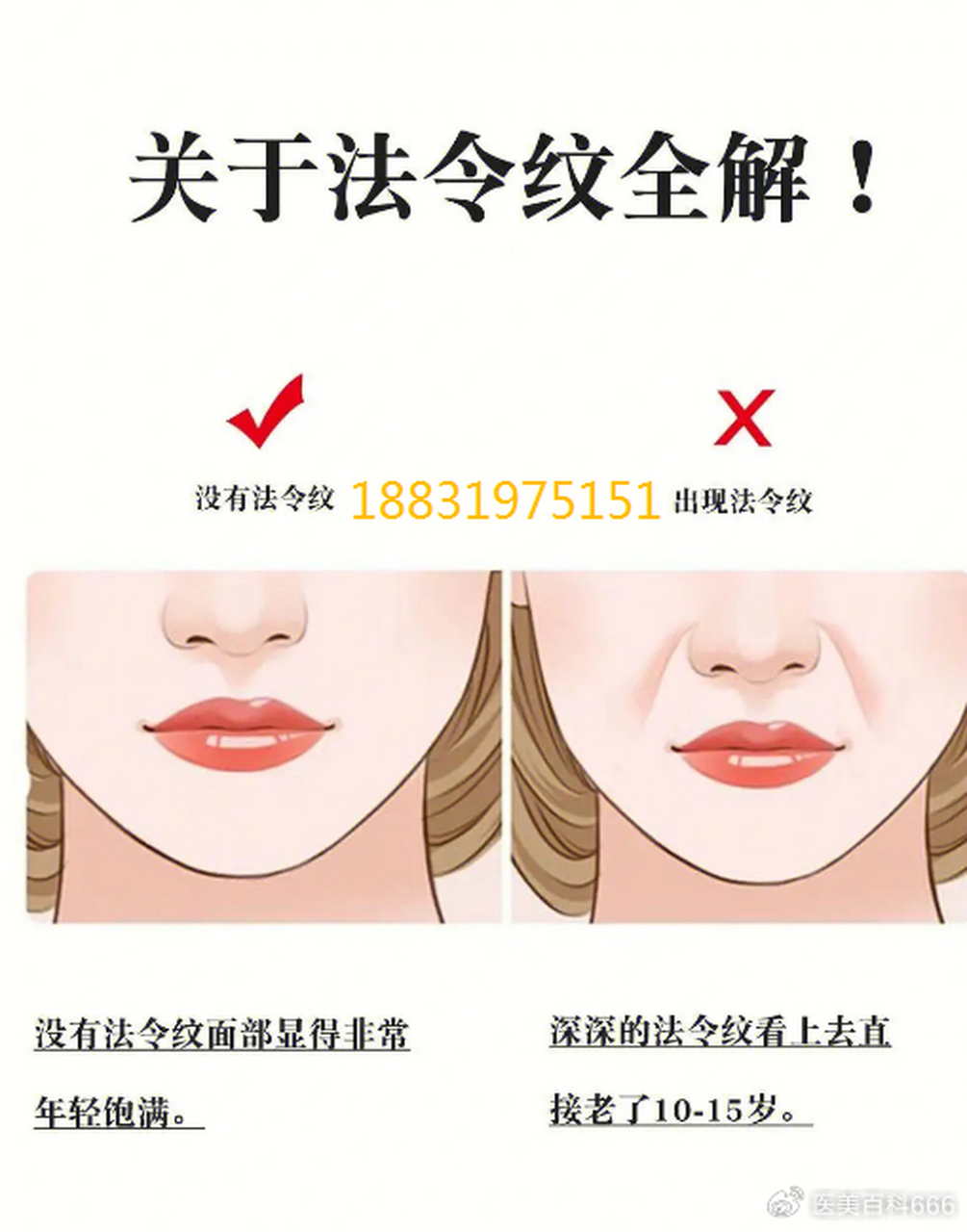 轻度法令纹 可以采用玻尿酸,适合法令纹较浅的人群,可以通过注射