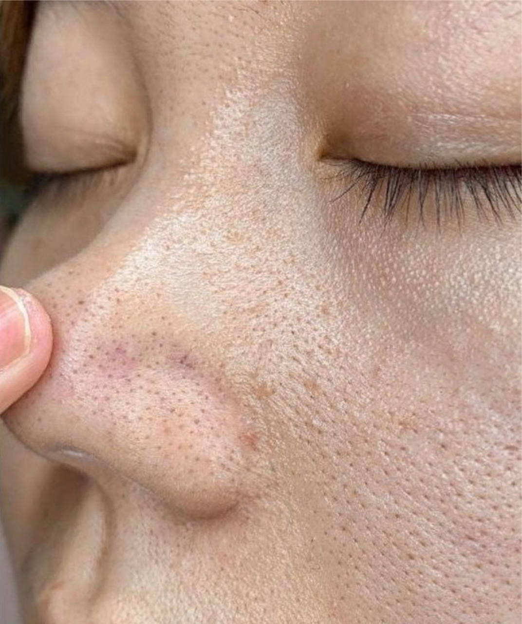 黑头和毛孔粗大通常与油脂分泌过多和不正确的皮肤护理有关