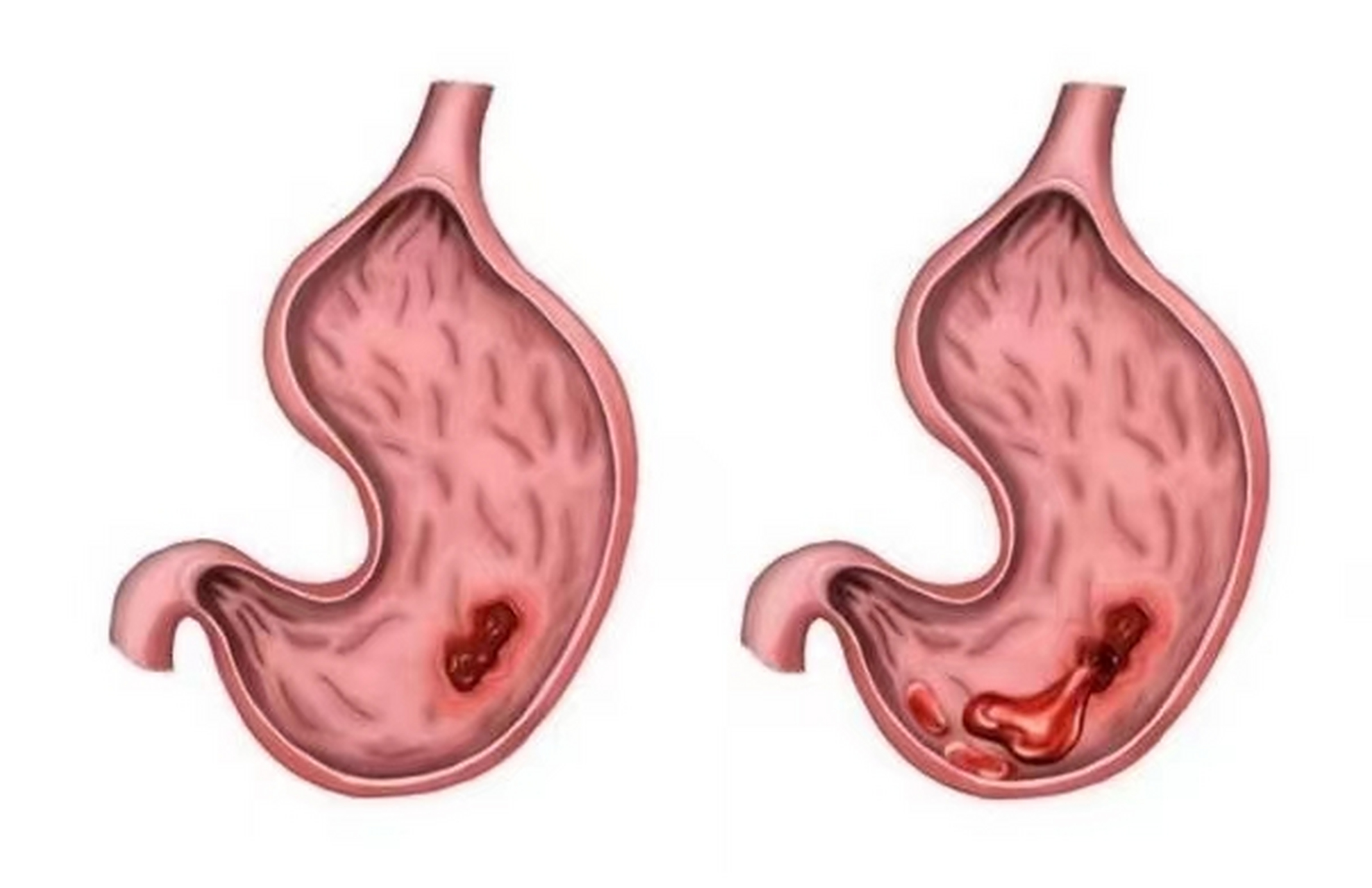 一般情况下,糜烂性胃炎是否严重?