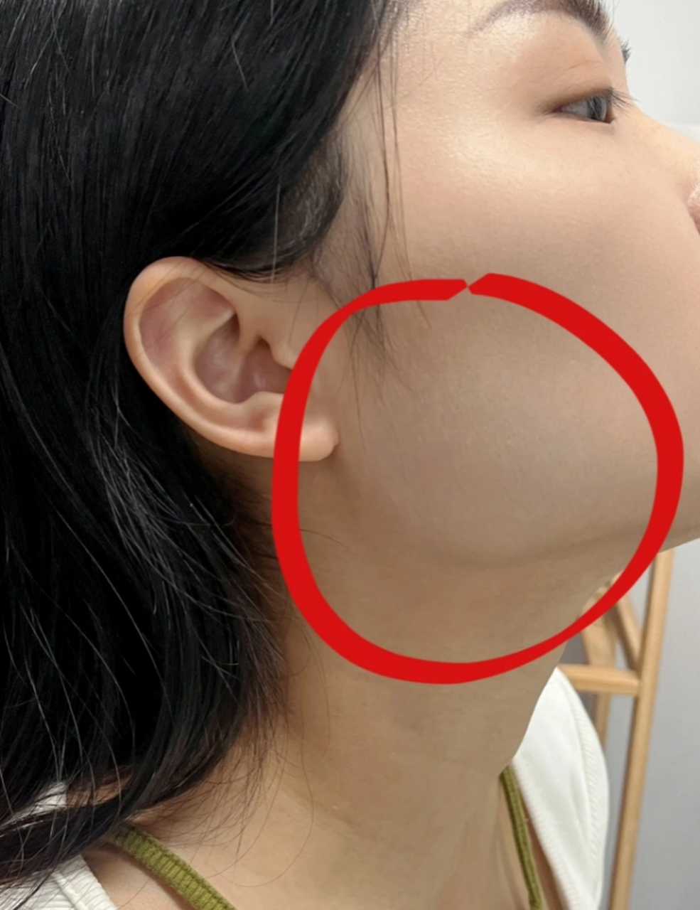 咬肌太大怎么自然消除?