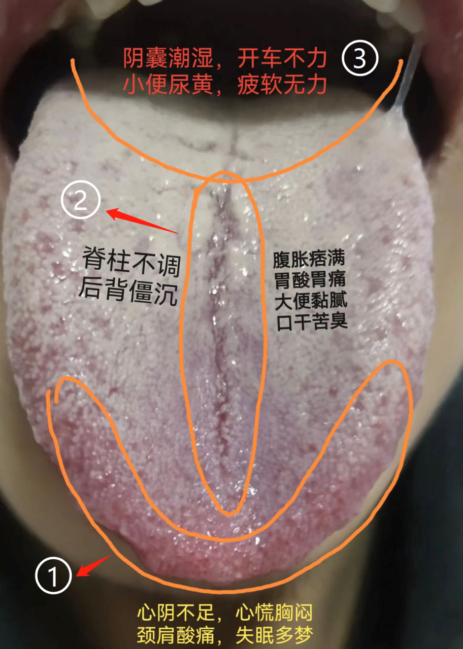 一位26岁男士,舌头上有一道长长的裂纹,而且阴囊潮湿,下焦湿热 标记1