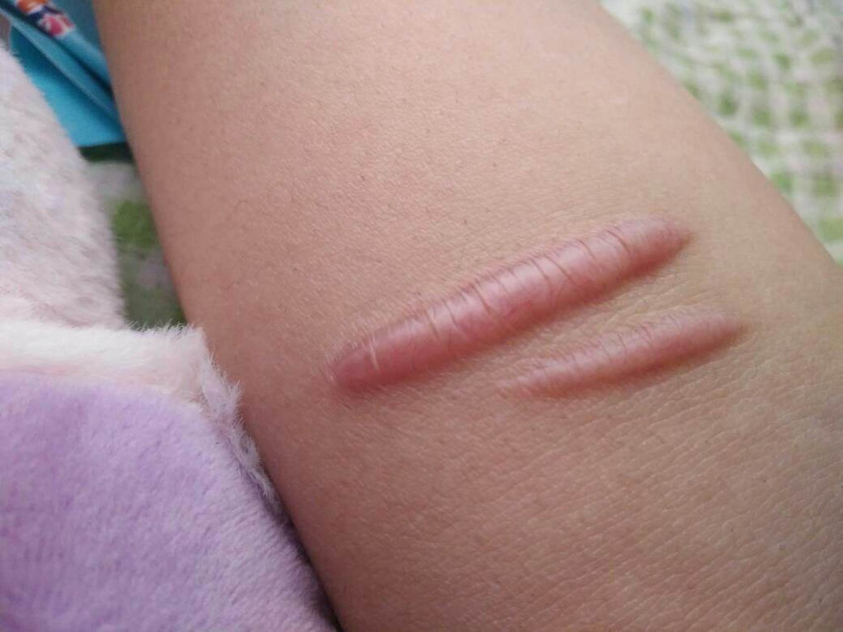 点阵激光能治疗凸起疤痕吗?