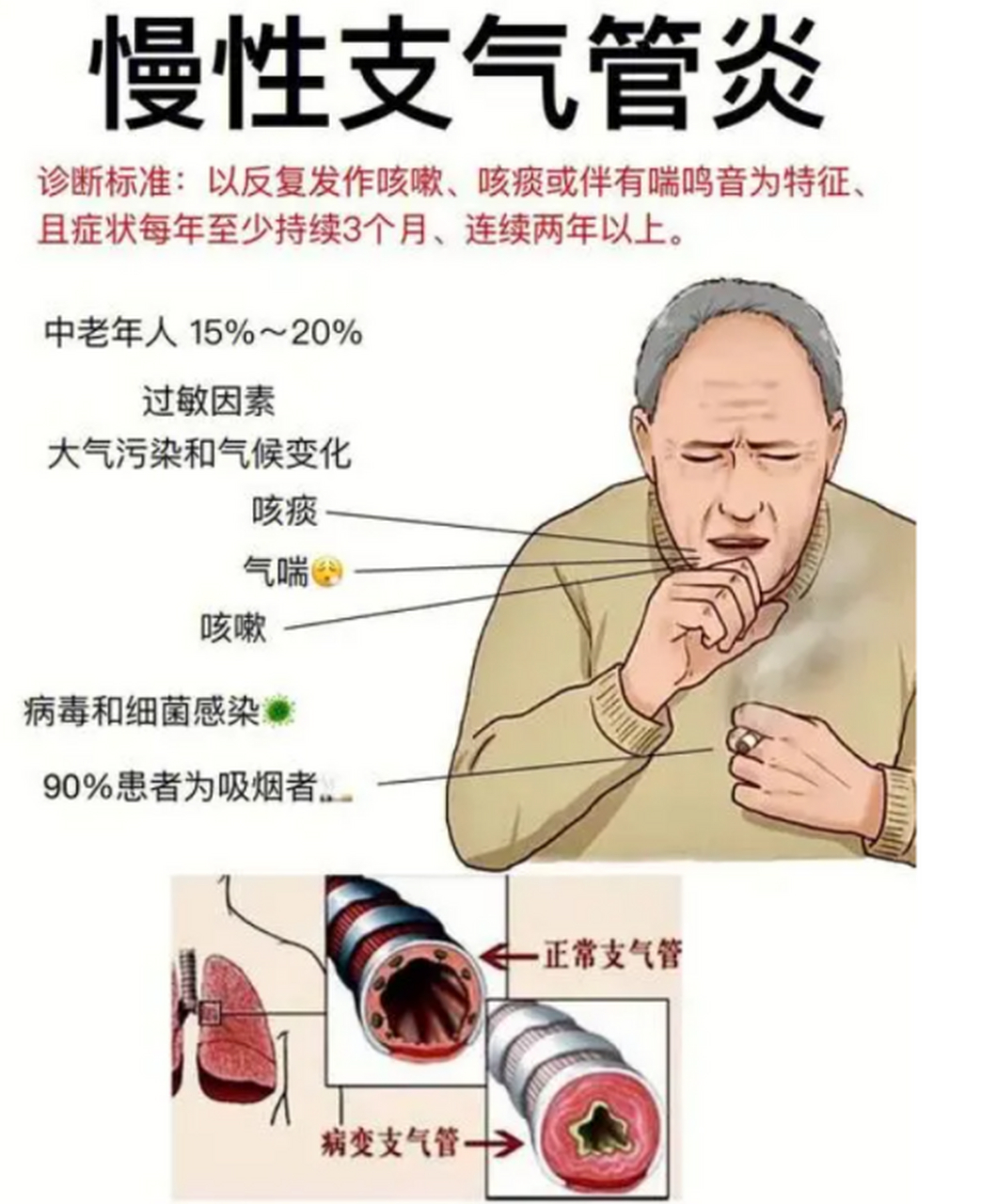 支气管扩张是一种慢性呼吸系统疾病,其病因可能涉及气道壁增厚,腺体