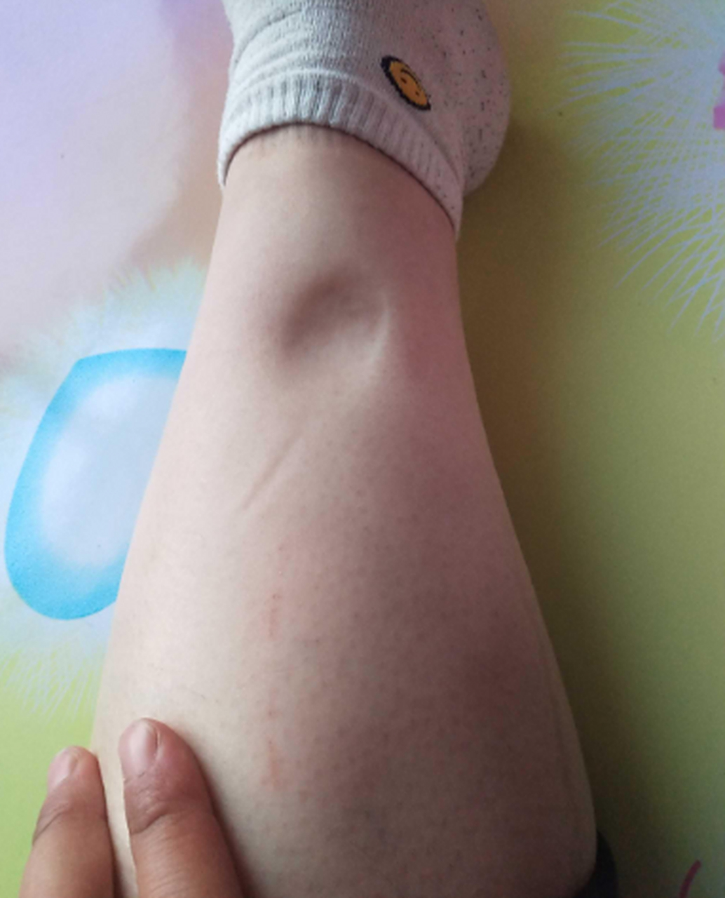 双腿下肢浮肿,一按一个坑咋回事?