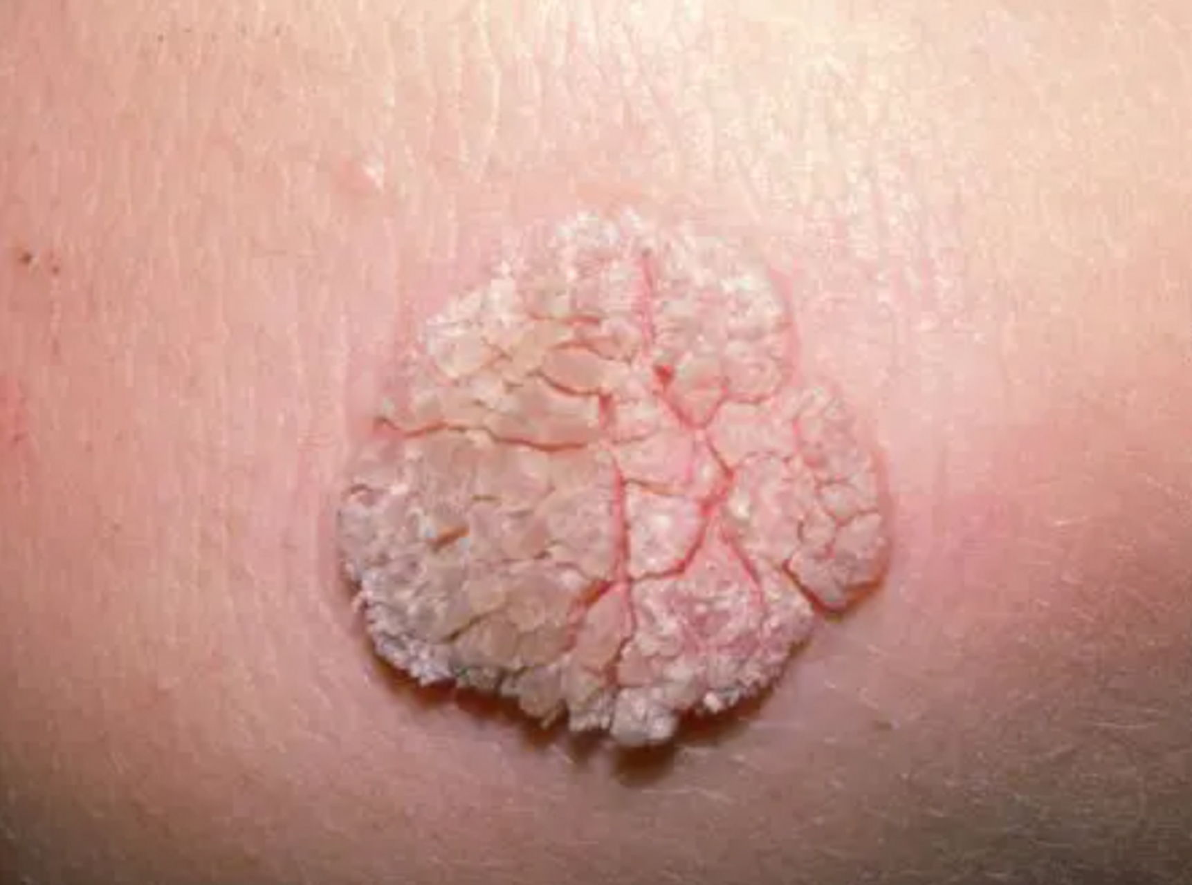 这种疣和尖锐湿疣一样,都是由人乳头瘤病毒(hpv