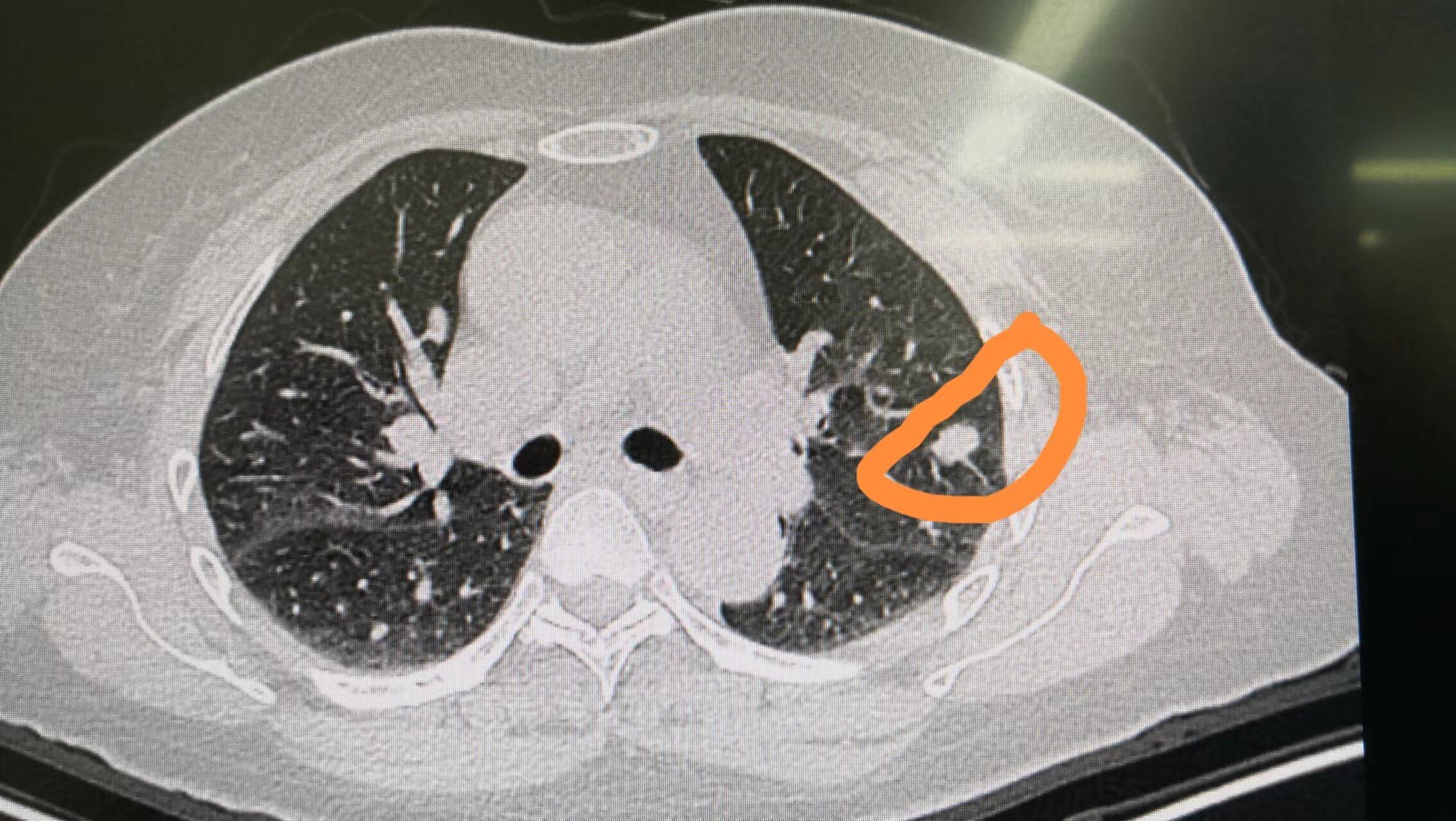 一碗水两味药,八毫米的肺结节一波冲走,这是怎么做到的?