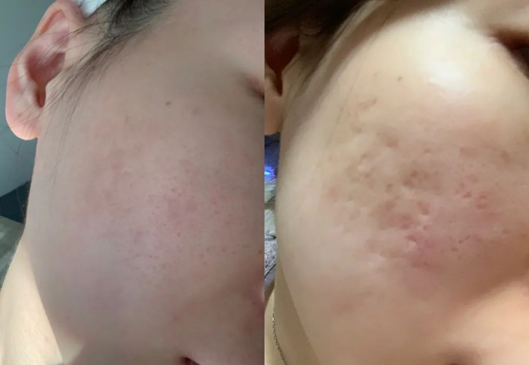 毛孔粗大的根源就是皮肤已经老化,激光点阵都已经将你这些老化的