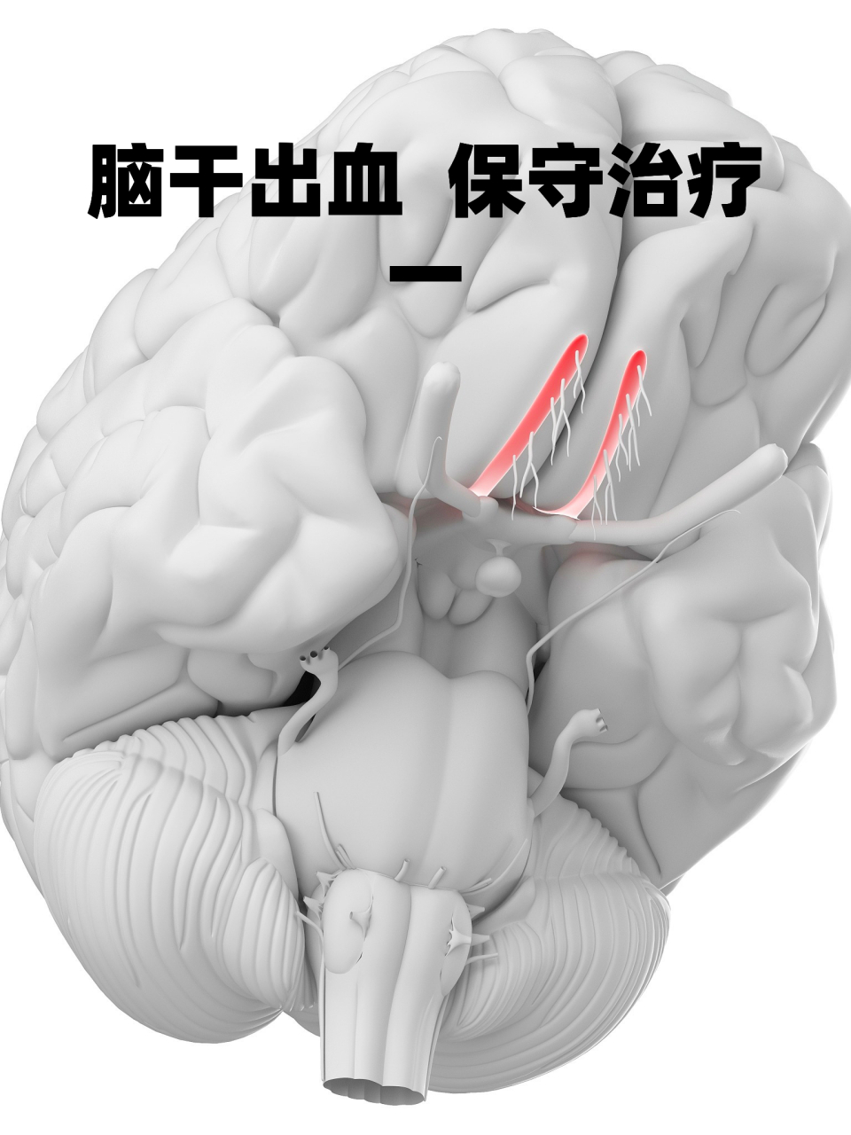 脑干出血 #脑干出血#  保守治疗 一 爸爸去年生病我做的记录,发出来给