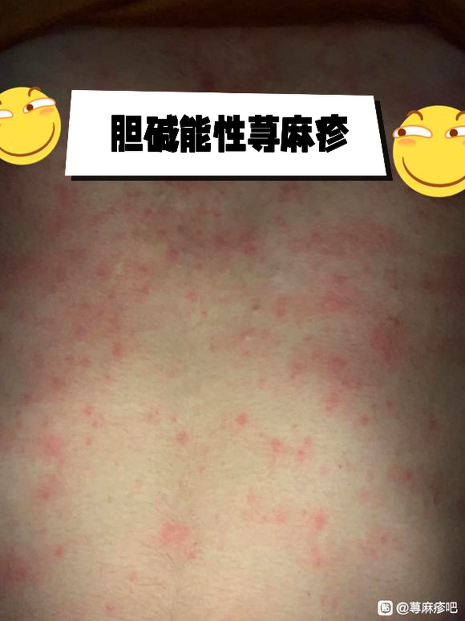 胆碱能性荨麻疹的兄弟姐妹们看过来#胆碱能性荨麻疹# #疾病治疗经验