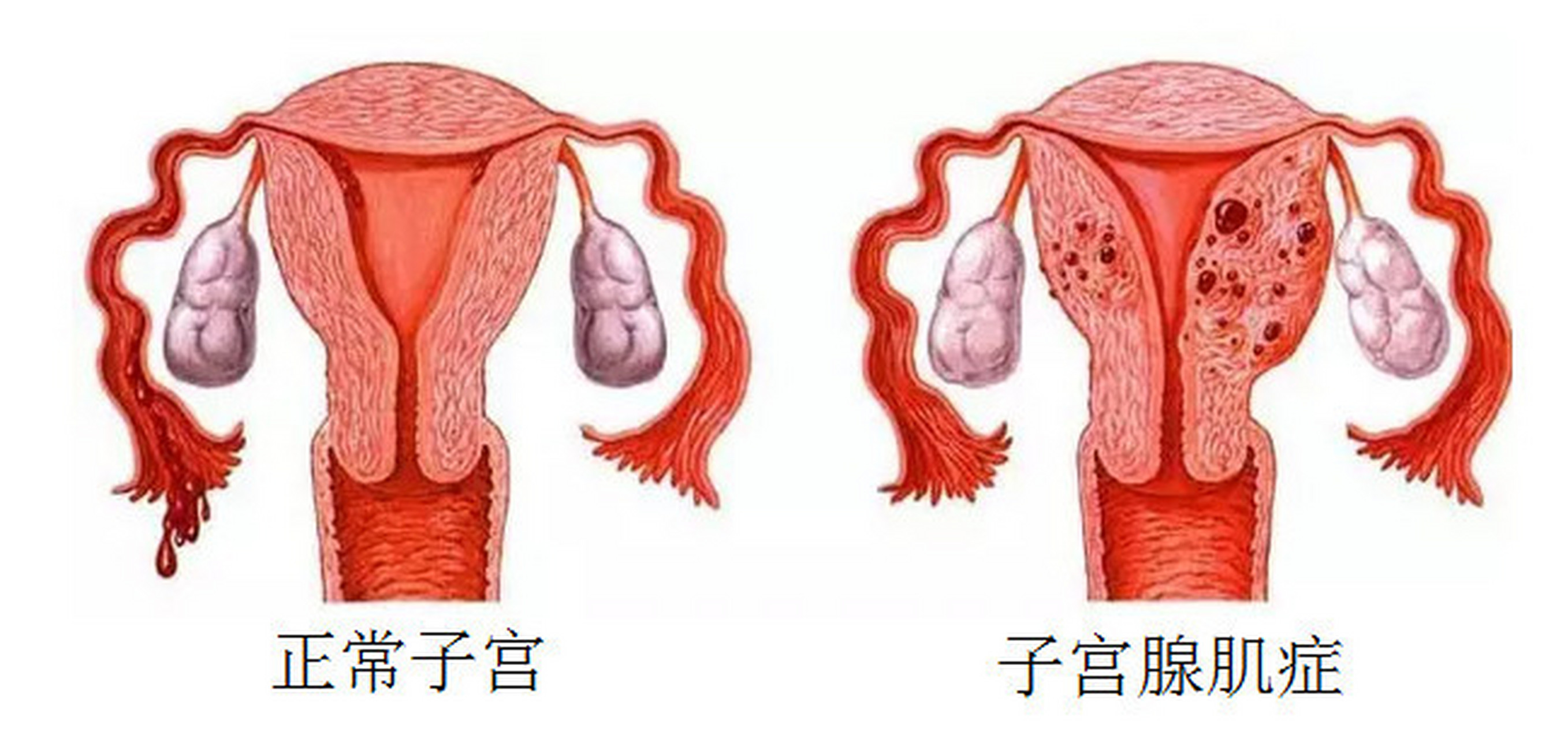 腺肌症图片