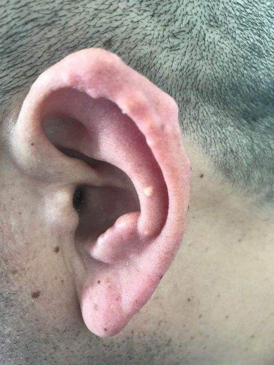 痛风石怎么消除# 耳后痛风结节的原因是什么?