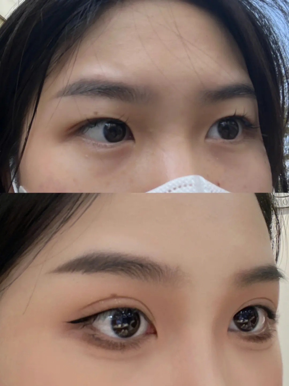 纳米无痕双眼皮能维持多久?