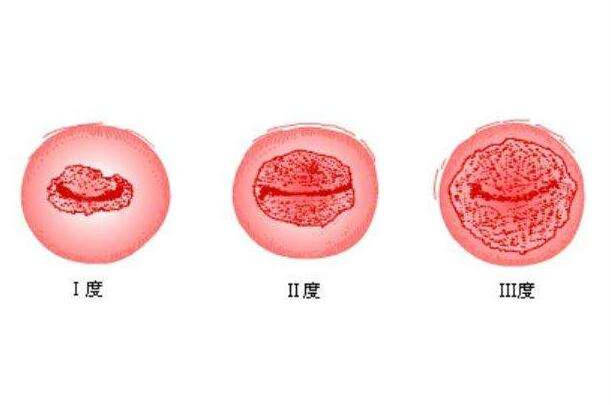 宫颈图片外翻图片