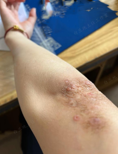 外用药物:如青鹏软膏,蜈黛软膏,丹皮酚软膏以及中药类的汤剂煎