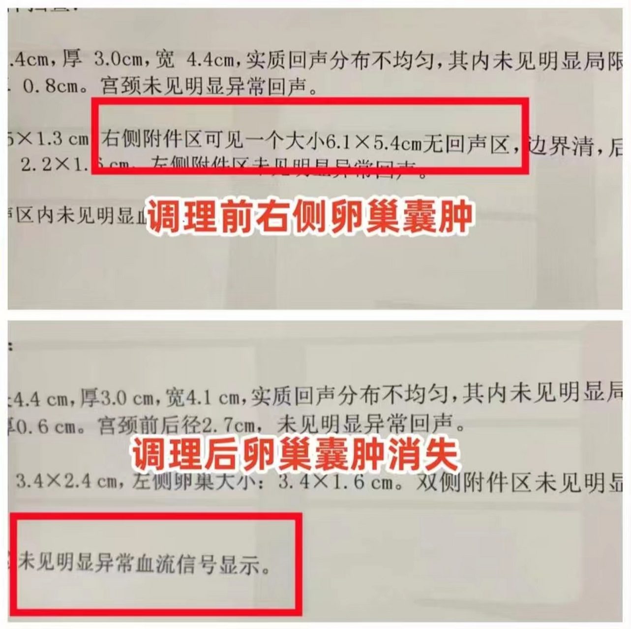 6公分的囊肿消失了 王女士检查发现右侧卵巢囊肿,下腹一直隐隐作痛.