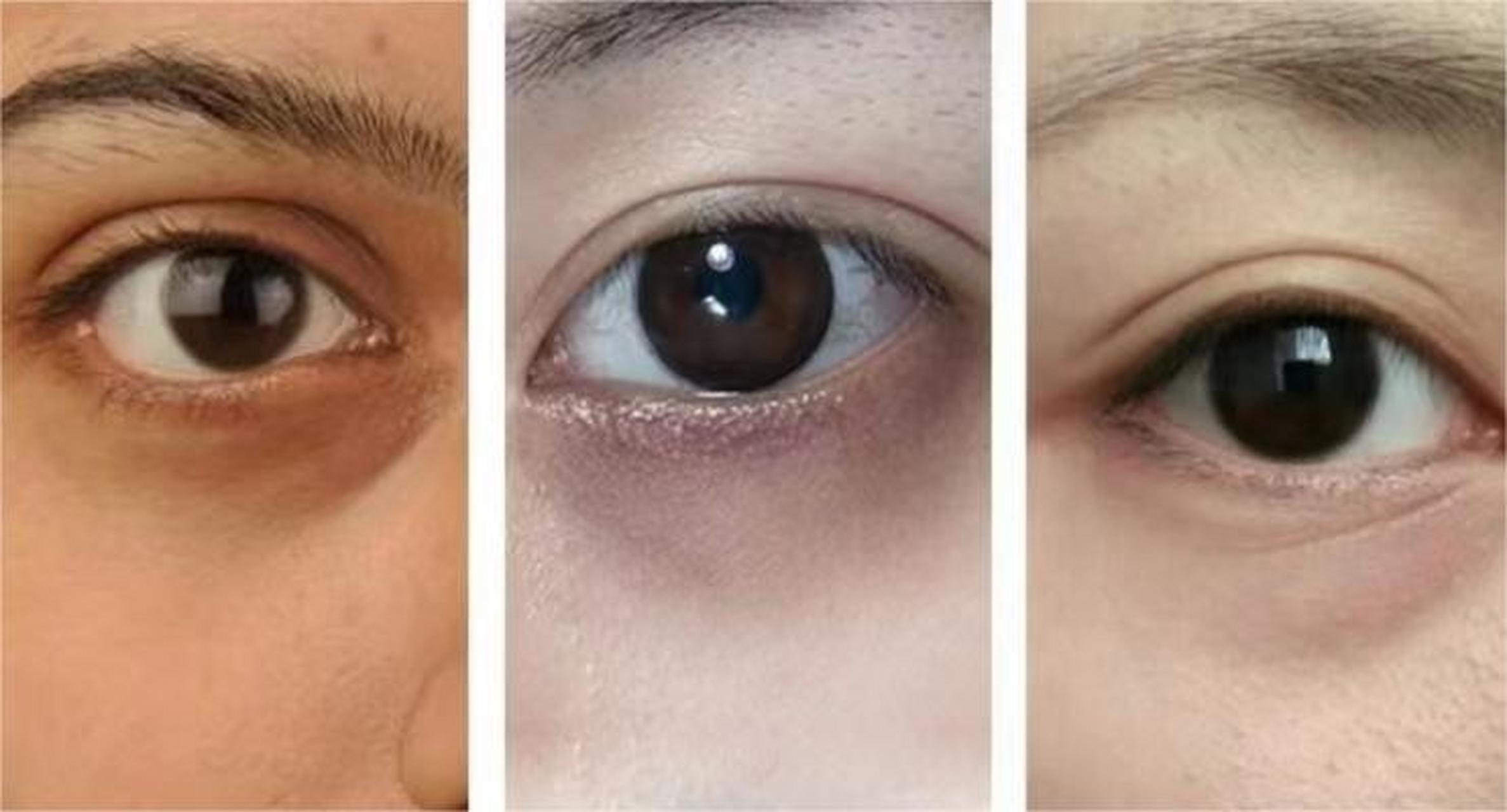 眼袋小课堂#   20s自测眼袋类型 1,水肿型眼袋.